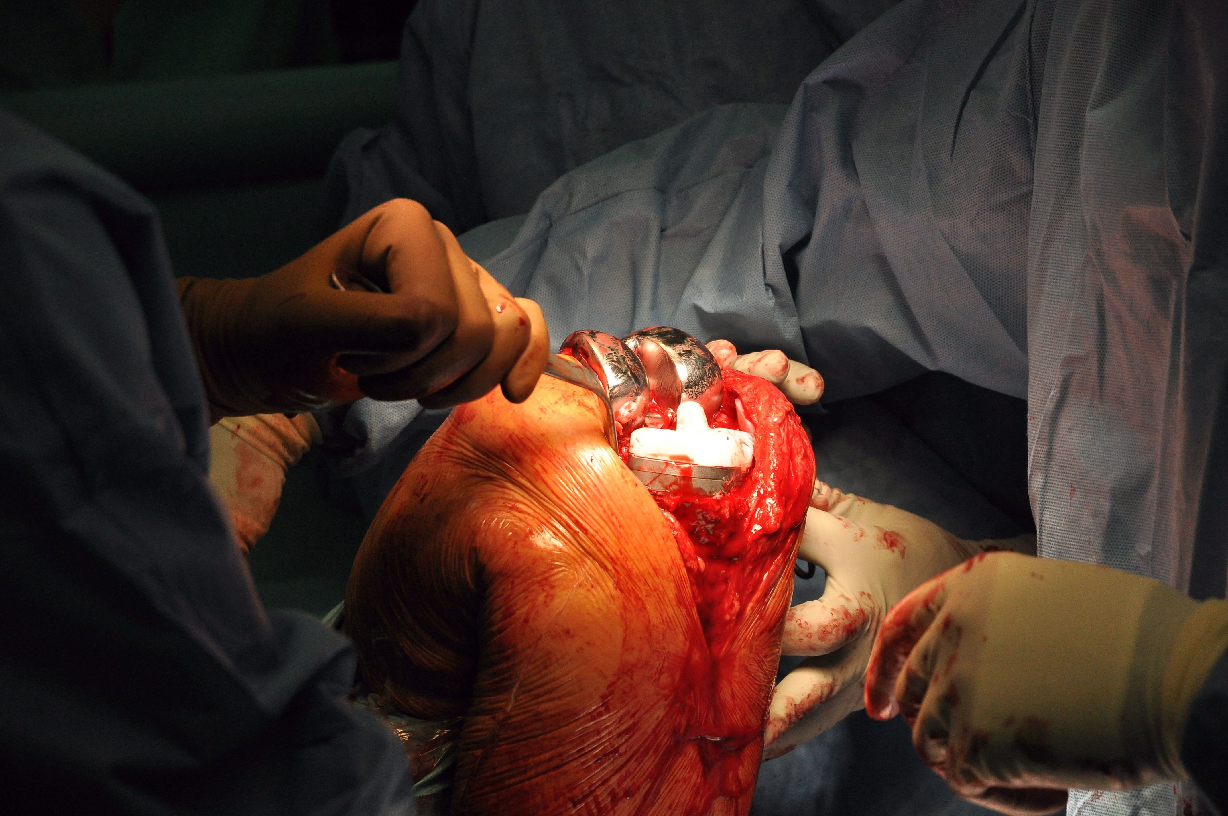 Operacja ukazująca wszczepienie endoprotezy kolana