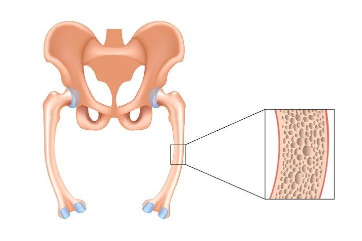 Osteomalacja - choroba metaboliczna